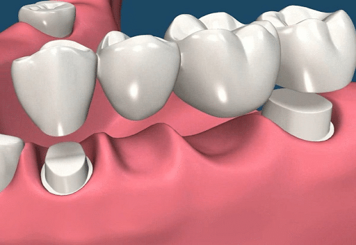 Ponciano Dental - Dental Bridges in Davisville