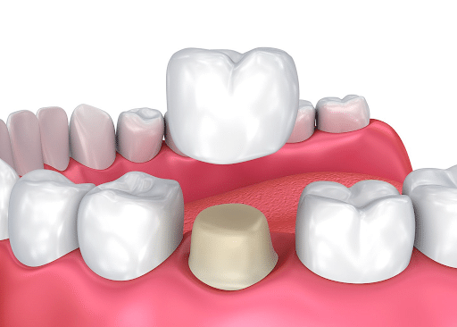 Ponciano Dental - Dental Crowns in Davisville