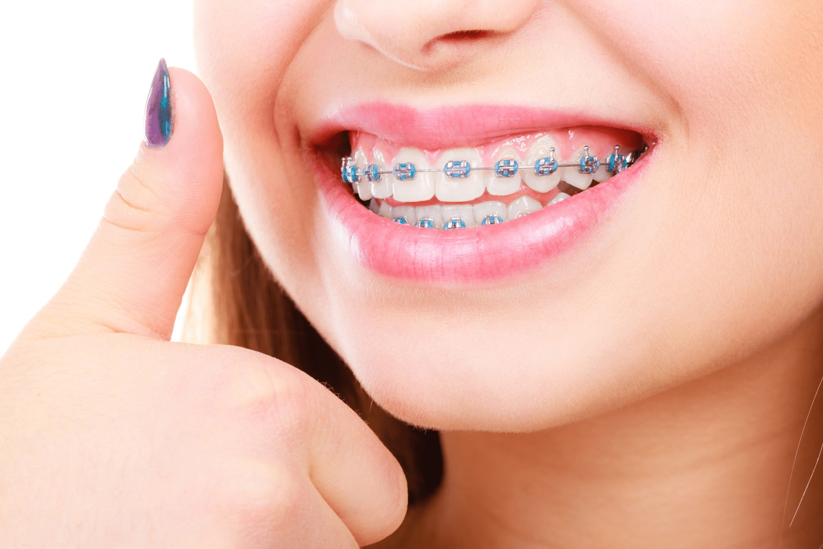 Ponciano Dental - Conventional Braces in Midtown Toronto