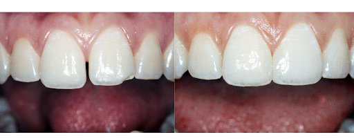 Ponciano Dental - Cosmetic Bonding in Midtown Toronto