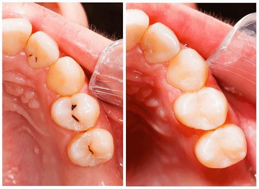 Ponciano Dental - Tooth Coloured Fillings in Midtown Toronto